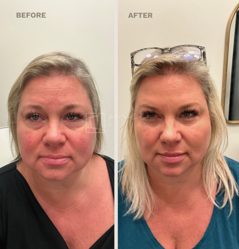 Injectables (11)