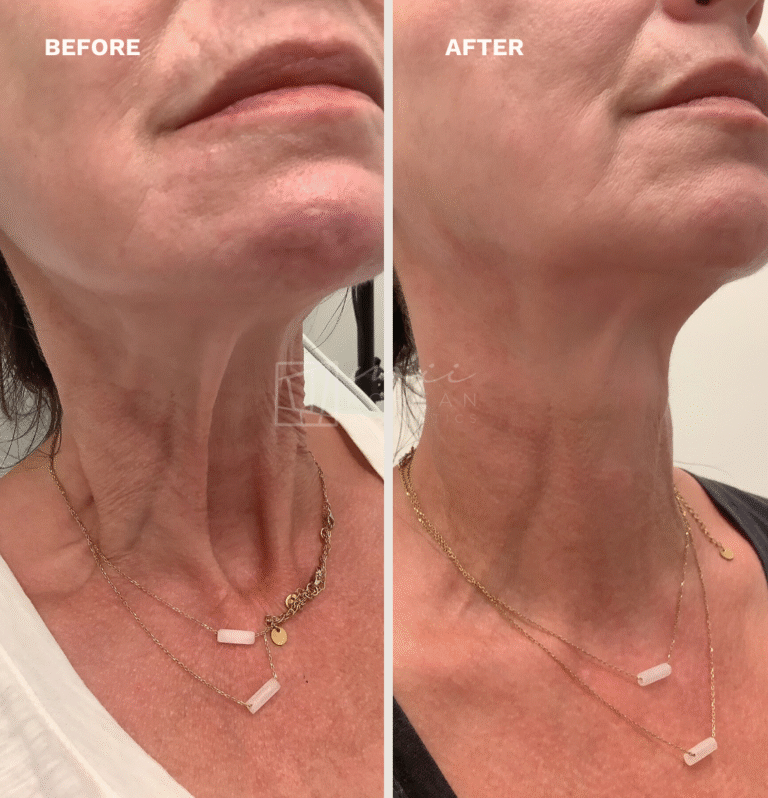 Injectables (14)