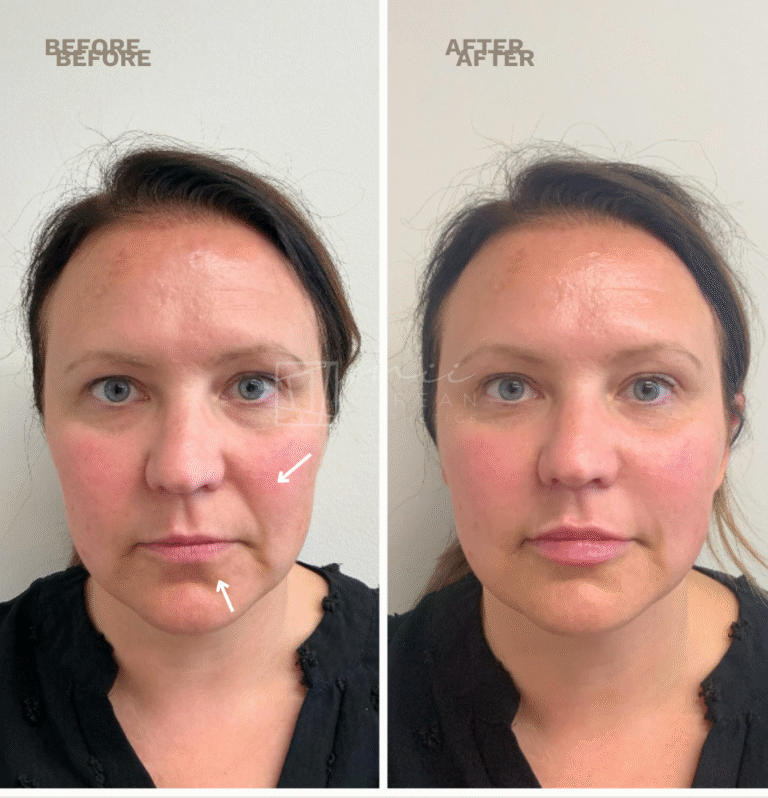 Injectables (15)