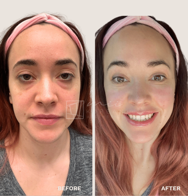 Injectables