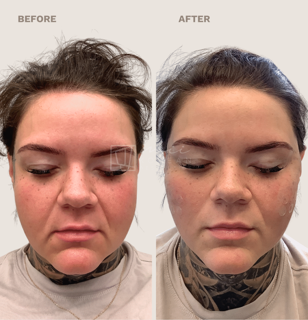 Lifting treatment (10)