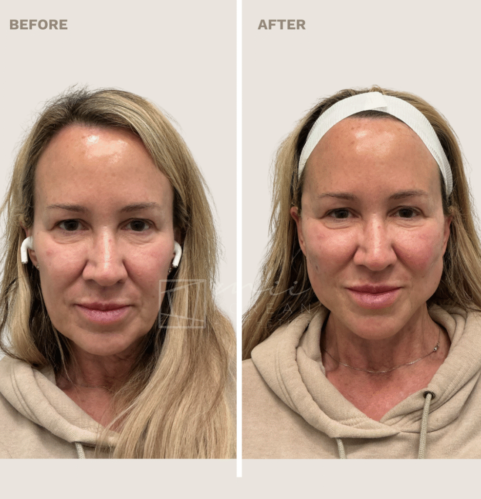 Lifting treatment (2)