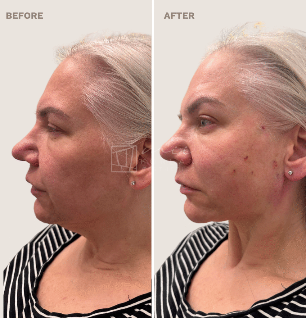 Lifting treatment (3)