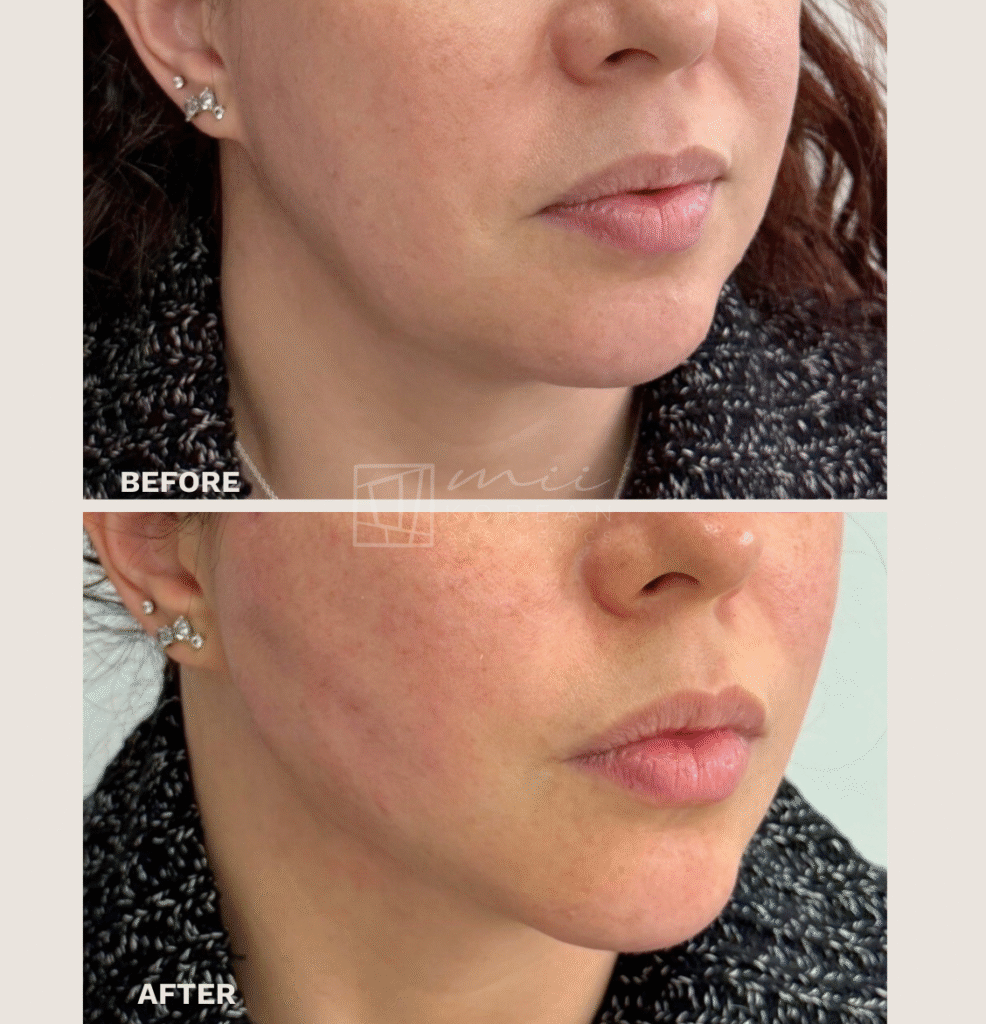 Lifting treatment (4)