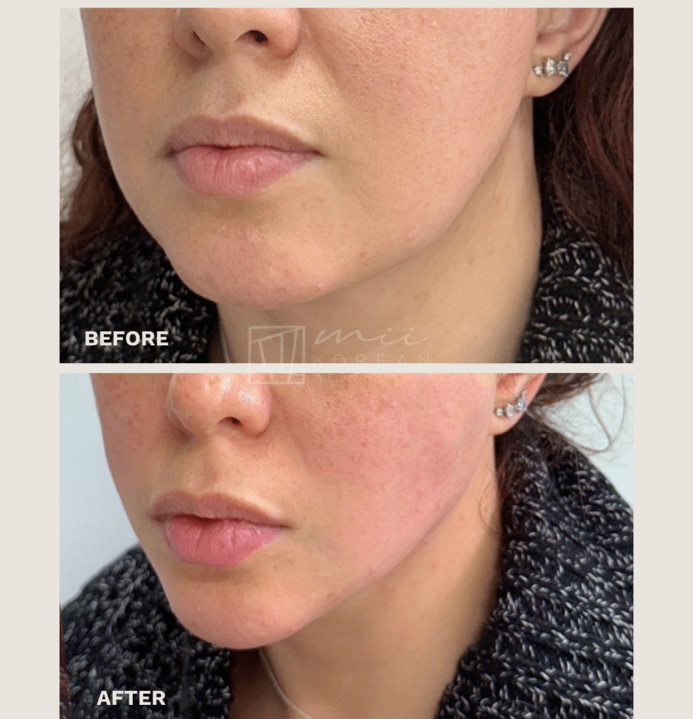 Lifting treatment (5)