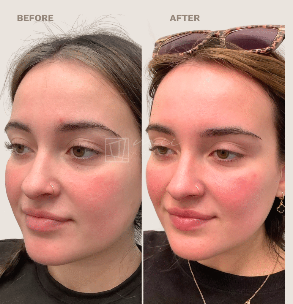 Lifting treatment (6)