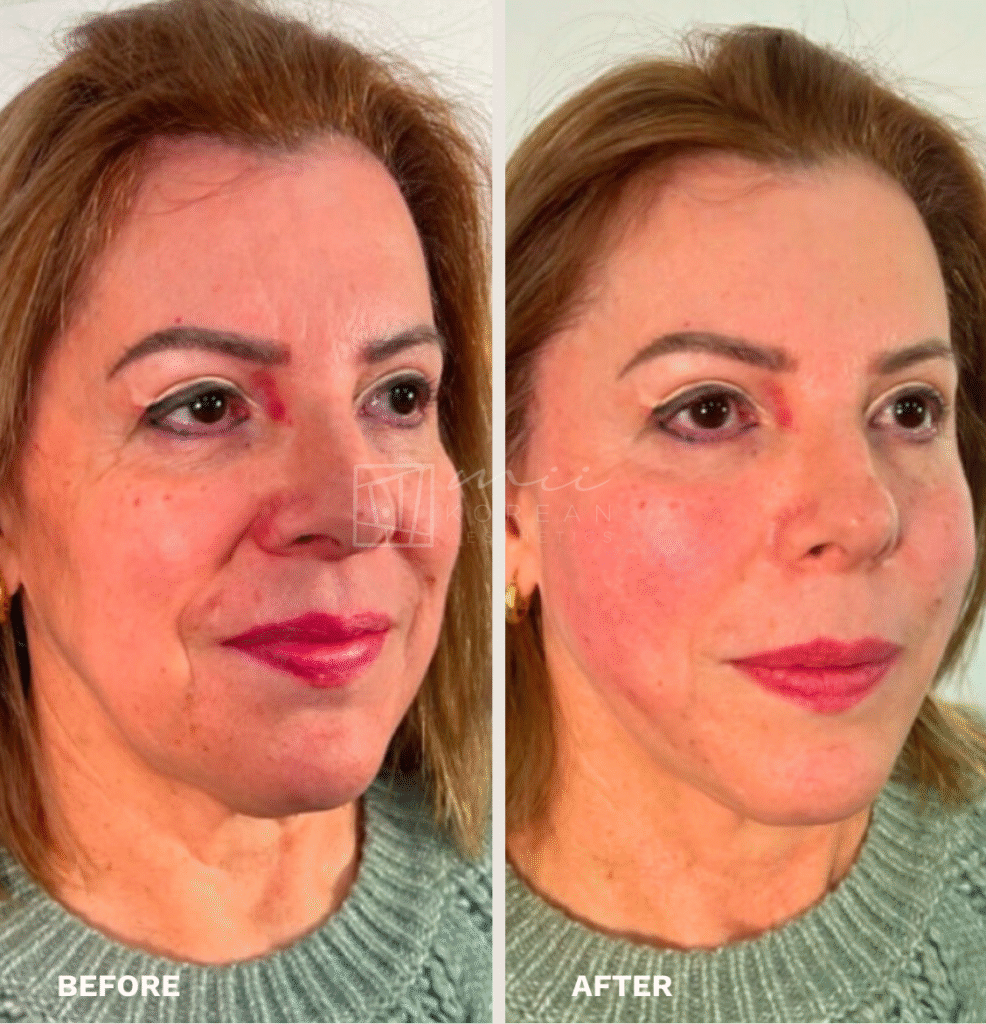 Lifting treatment (7)