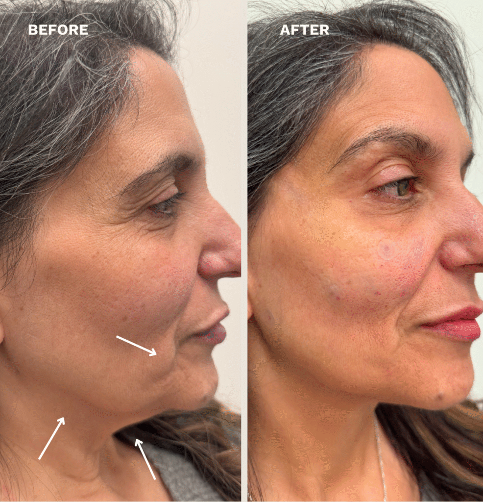 Lifting treatment (8)