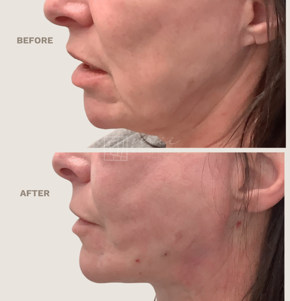 Lifting treatment (9)