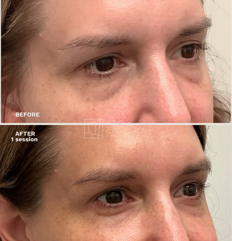 Regenerative treatment
