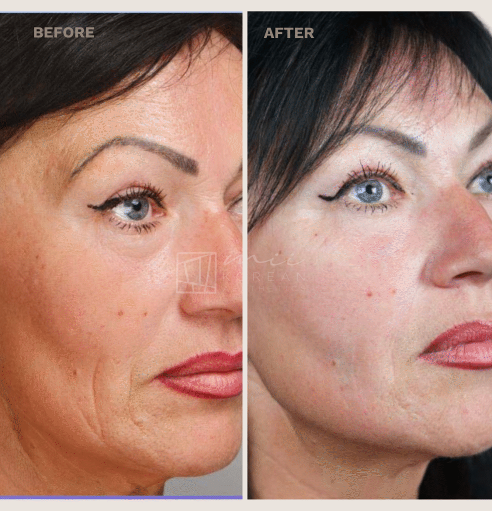 Regenerative treatment