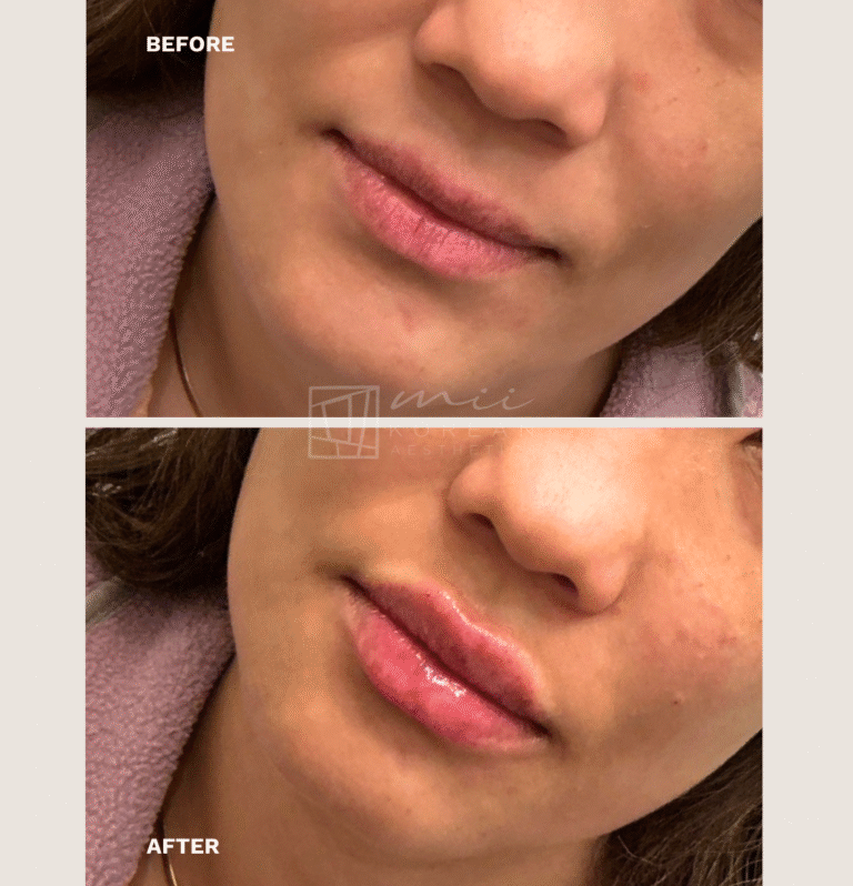 lip filler (4)