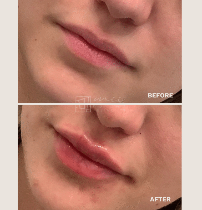 lip filler (5)
