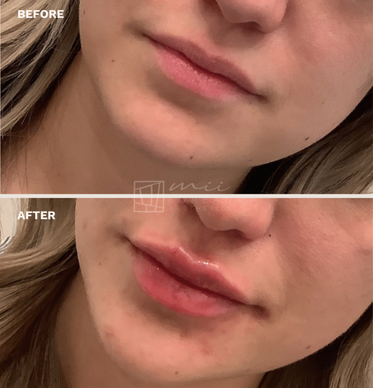 lip filler (6)