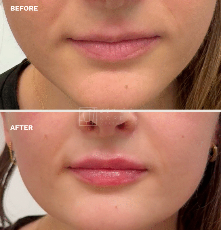 lip filler (7)