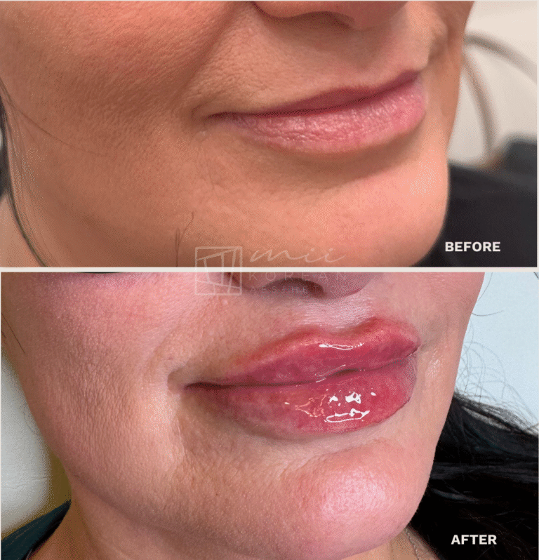 lip filler