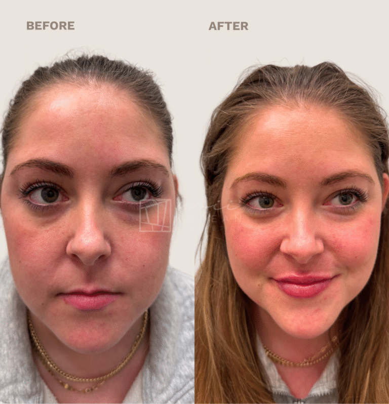 lip filler (9)