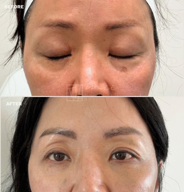 INJECTABLES