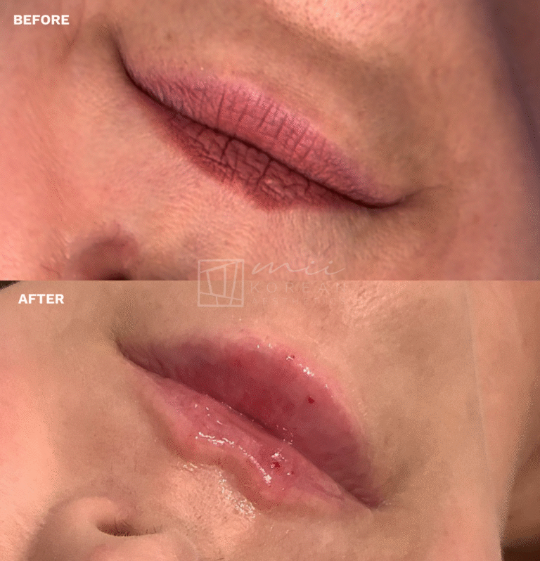 lIP (2)