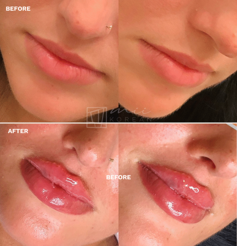 lIP